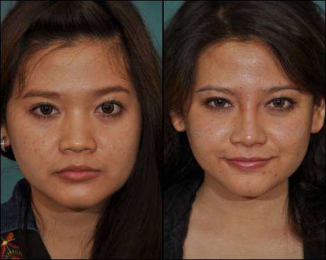 Bioplastia para aumentar o nariz - fotos antes e depois